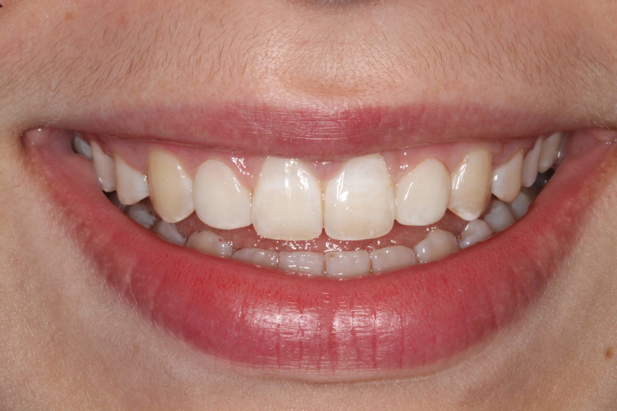 Sharp Dentistry | Inlays amp Onlays, Extractions and Oral Exams