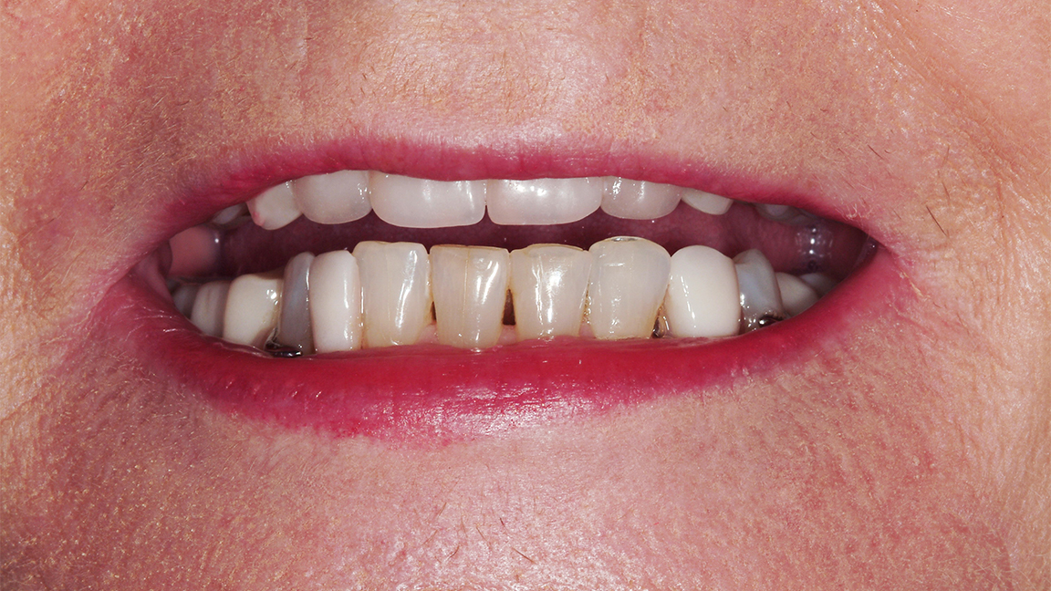 Sharp Dentistry | Extractions, Sleep Apnea and Implant Restorations