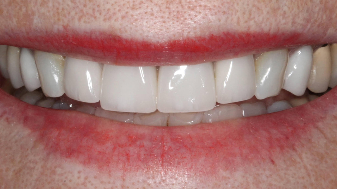 Sharp Dentistry | All-on-6®, Sleep Apnea and Implant Dentistry