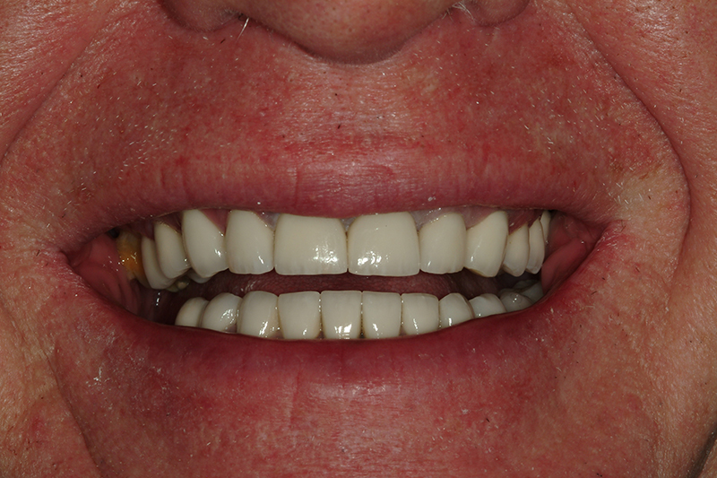 Sharp Dentistry | Inlays amp Onlays, Sinus Augmentation and Dentures